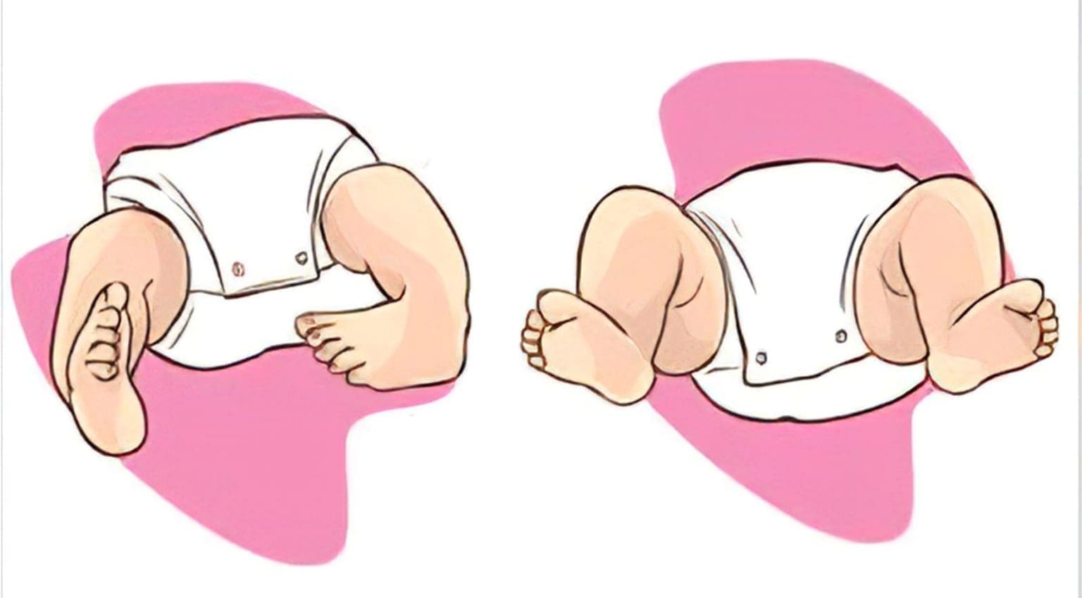 7 Arthrogryposis