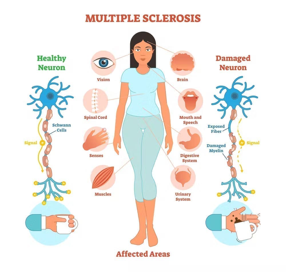 Multiple sclerosis diagram